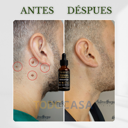 ANTIWARTS ©️ Tumba Verrugas X 2unidades